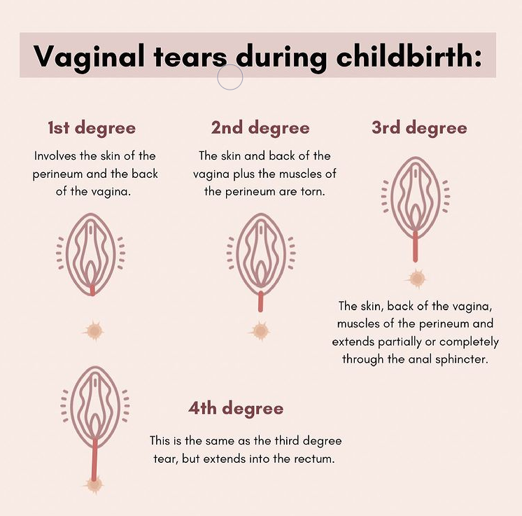 Perineal Tear & Episiotomy